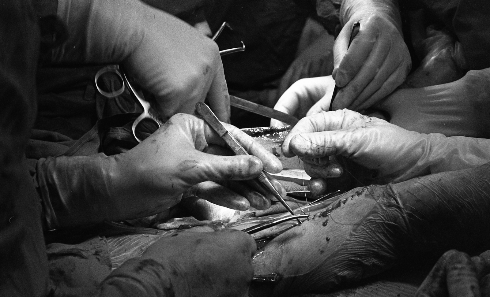 Hungary, Budapest VIII., Fiumei (Mező Imre) út, Baleseti Intézet, sürgősségi műtét., 1986, Urbán Tamás, surgery, gloves, Budapest, surgeon, forceps, hand, Fortepan #125990